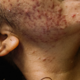 Woman with acne and hirsutism symptoms due to PCOS